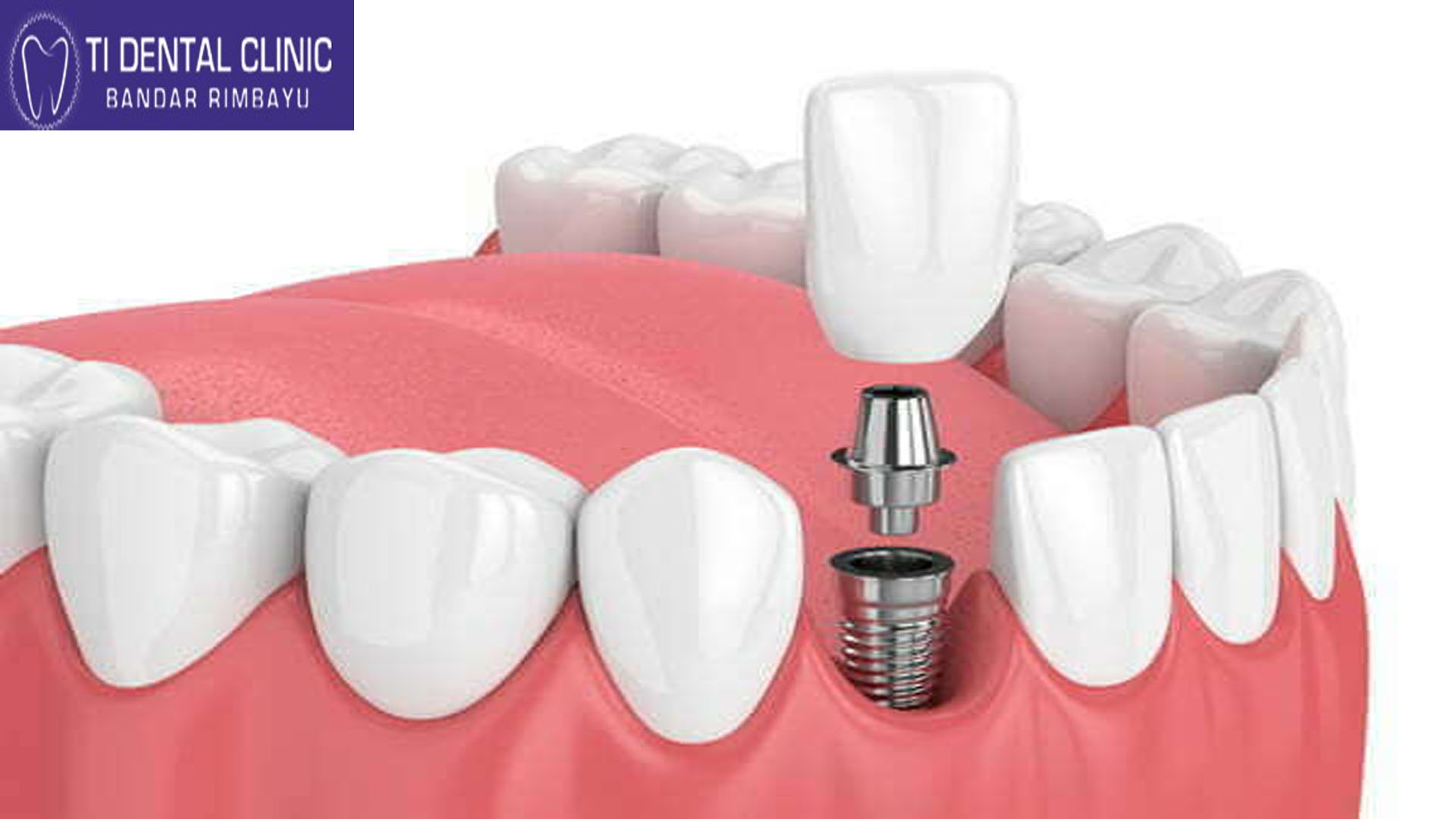 Long-Term Care and Maintenance of Teeth Veneers — Protecting Your Smile Investment