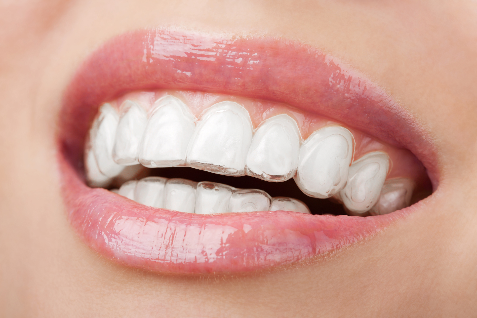 Everything You Need to Know About Dental Implants and Invisible Braces
