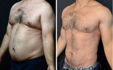 Turkey’s Liposuction Market in Focus: Dr. Hüseyin Kandulu Shares a North America–Focused Briefing as Demand for Body Contouring Continues to Rise