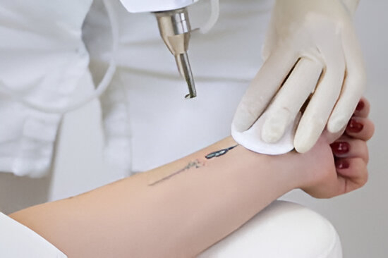 Can You Remove Part of a Tattoo? Selective Tattoo Removal Explained