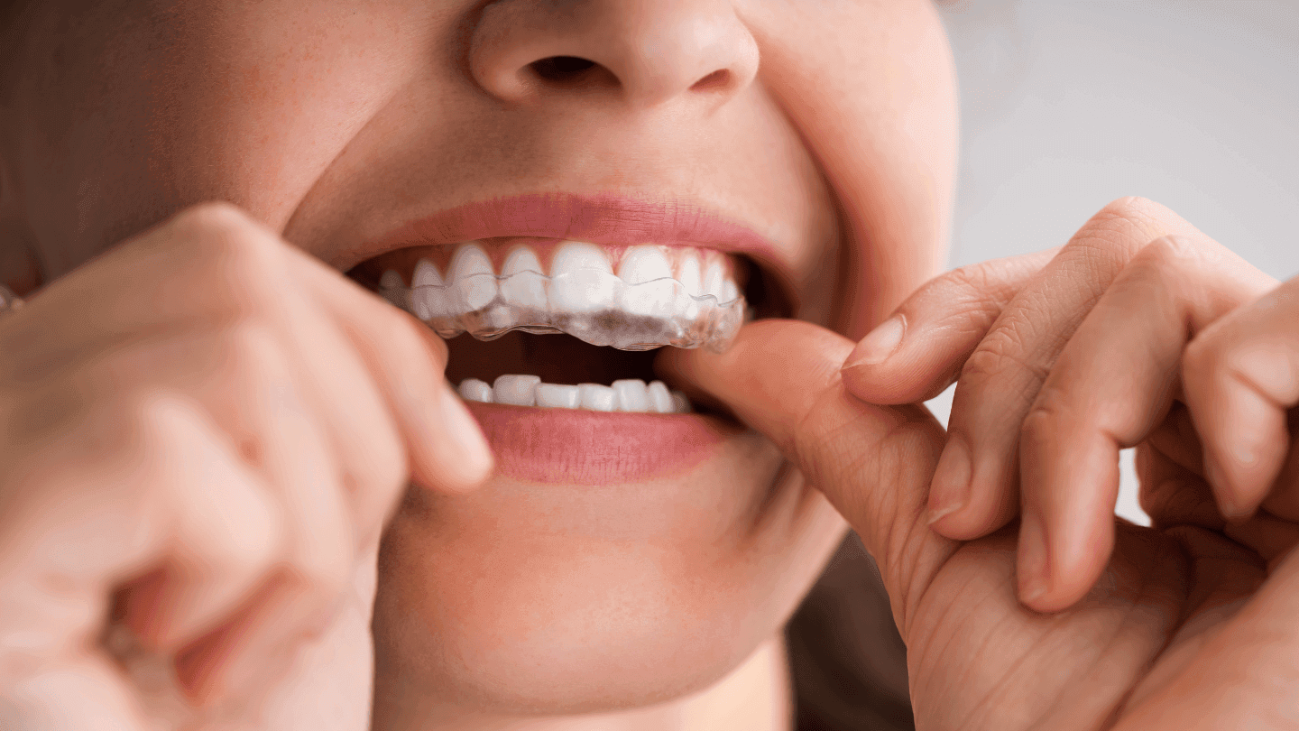 Best Aligners Dubai