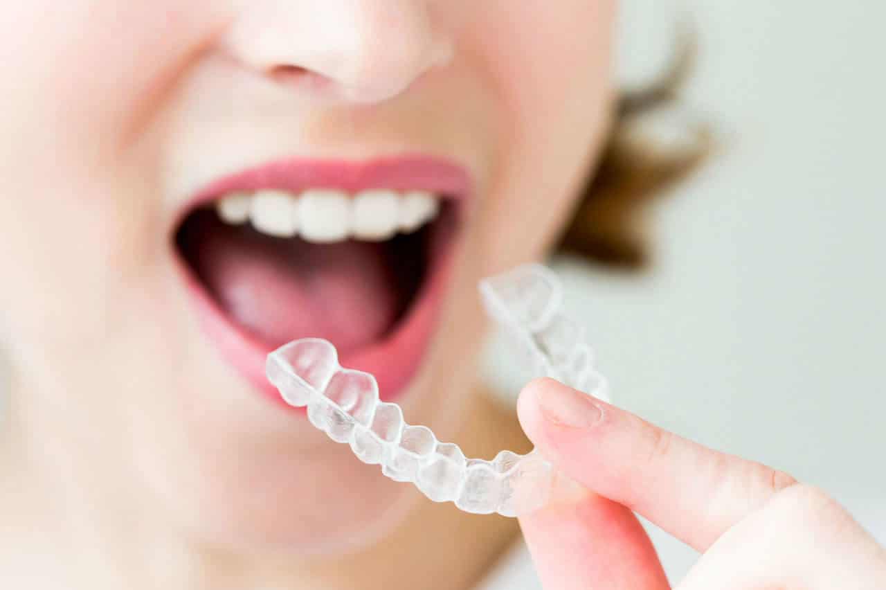 Best Aligners in Dubai