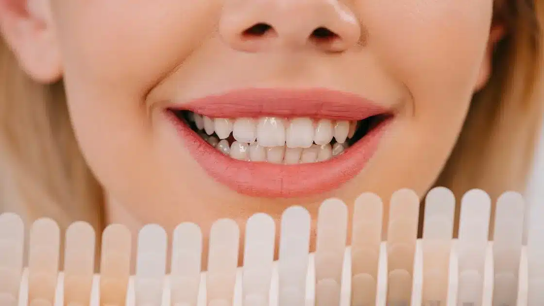 Composite veneers dubai