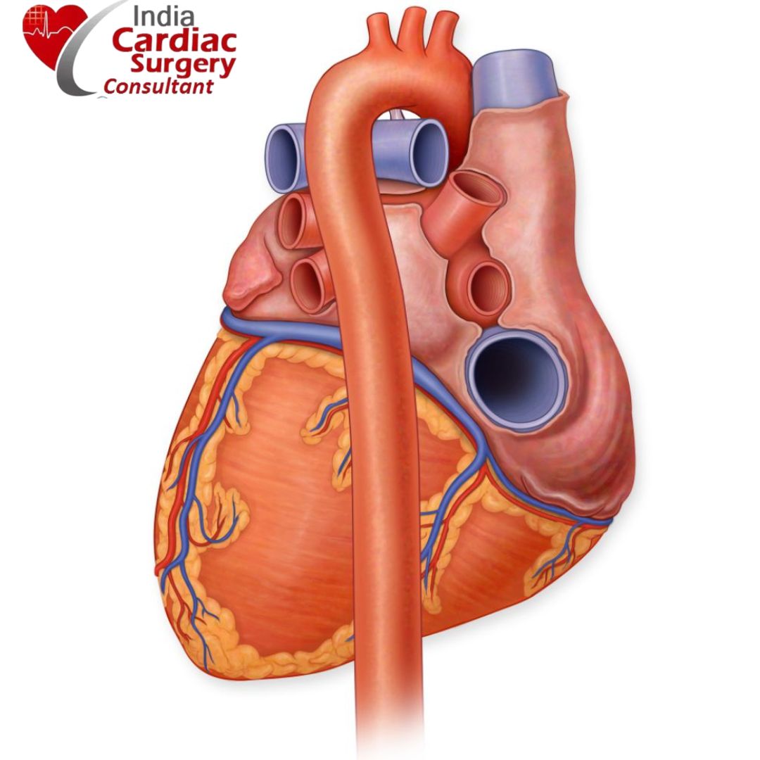 Endovascular Aneurysm Repair India