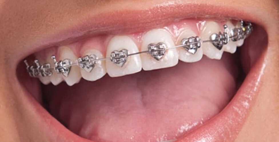 Teeth Braces in Dubai