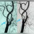 Interventional Cardiologist successfully performs a rare Carotid Stent