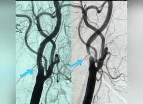 Interventional Cardiologist successfully performs a rare Carotid Stent