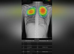 To Detect Chest X-ray Abnormalities, Including Pneumonia Caused by COVID-19 & Tuberculosis GE Healthcare Launches New AI Suite 